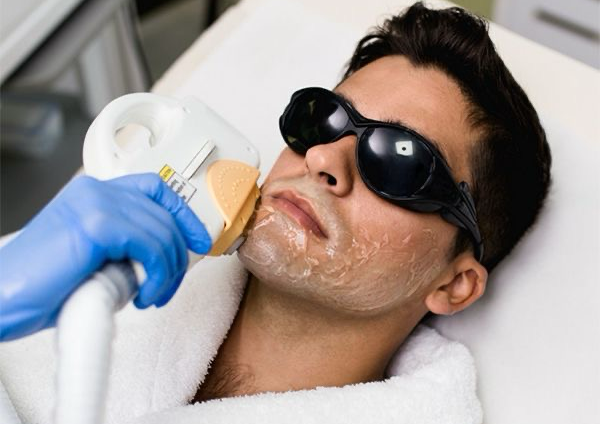 Marcacion de Barba (5 sesiones)