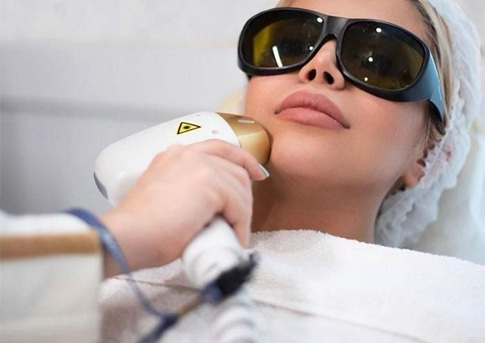 Mentón (5 sesiones)