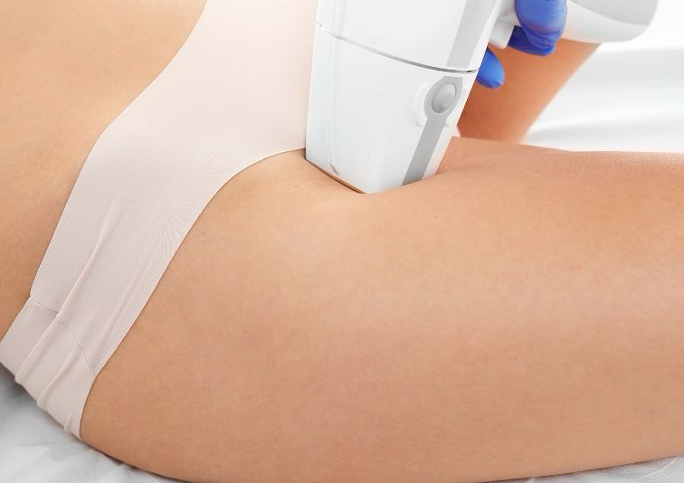 Bikini Line (5 sesiones)