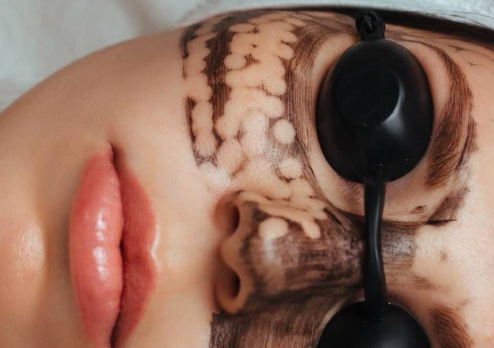 Hollywood Peel Facial (5 session)