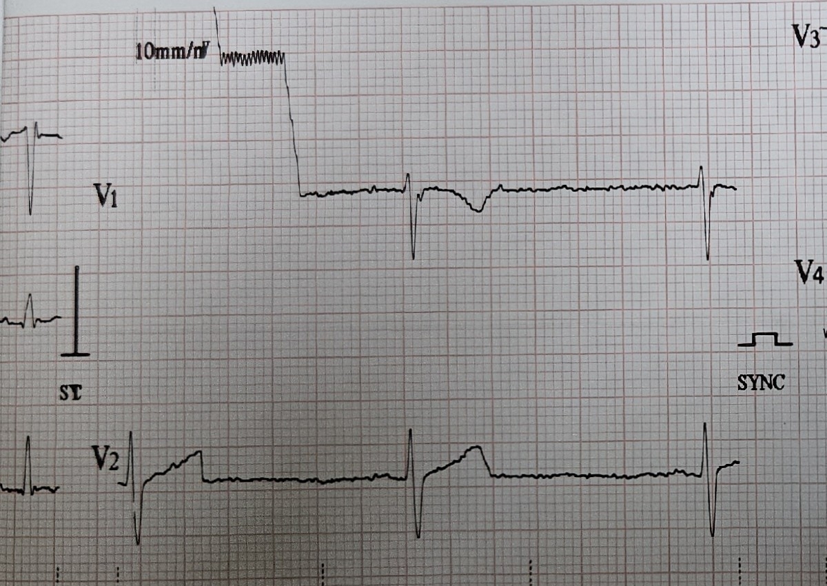EKG
