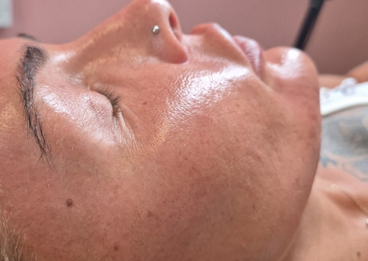 Microneedling with Derma 