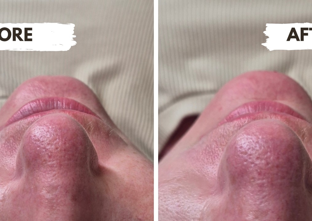 Chin Filler