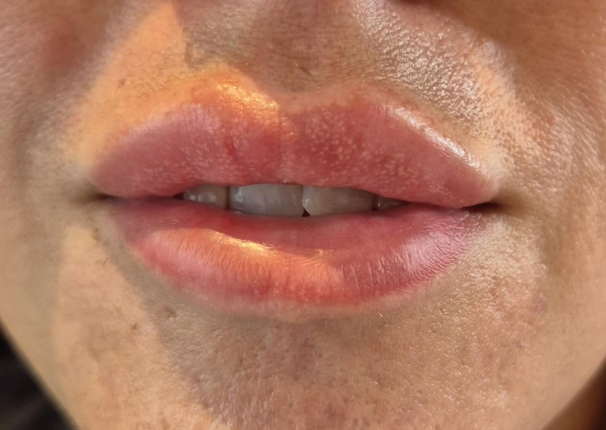 1ml Classic Lips