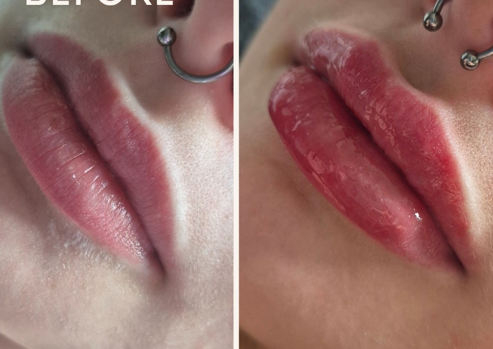 1ml Russian Lips. 