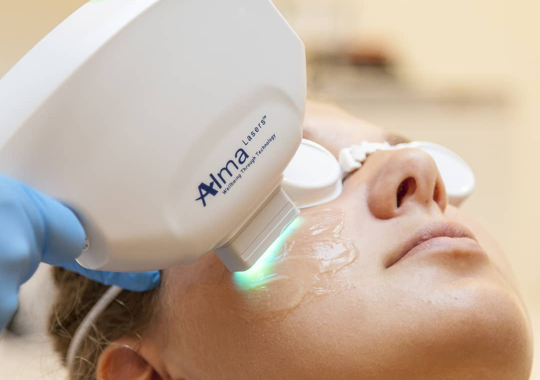 Photofacial (face or chest)