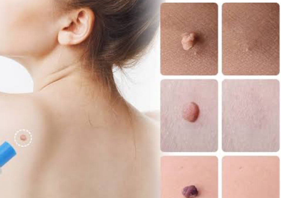 Skin tags removal 