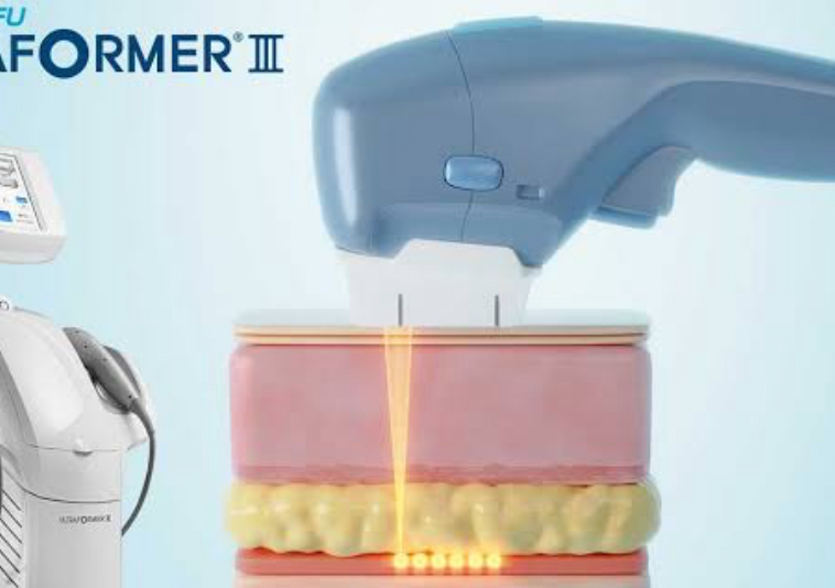 Ultraformer Fat Reduction (7D塑形)