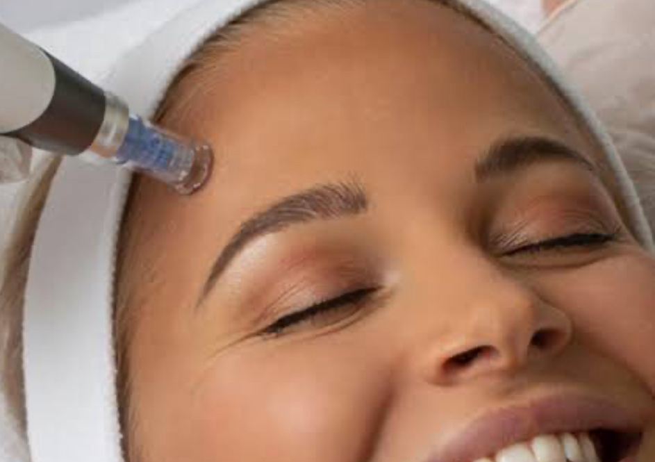 Micro needling 