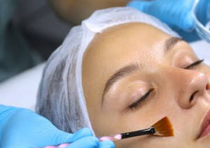 Chemical Peel