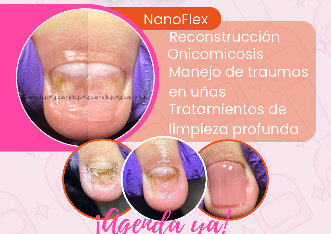 Nano Flex (Reconstruccion)