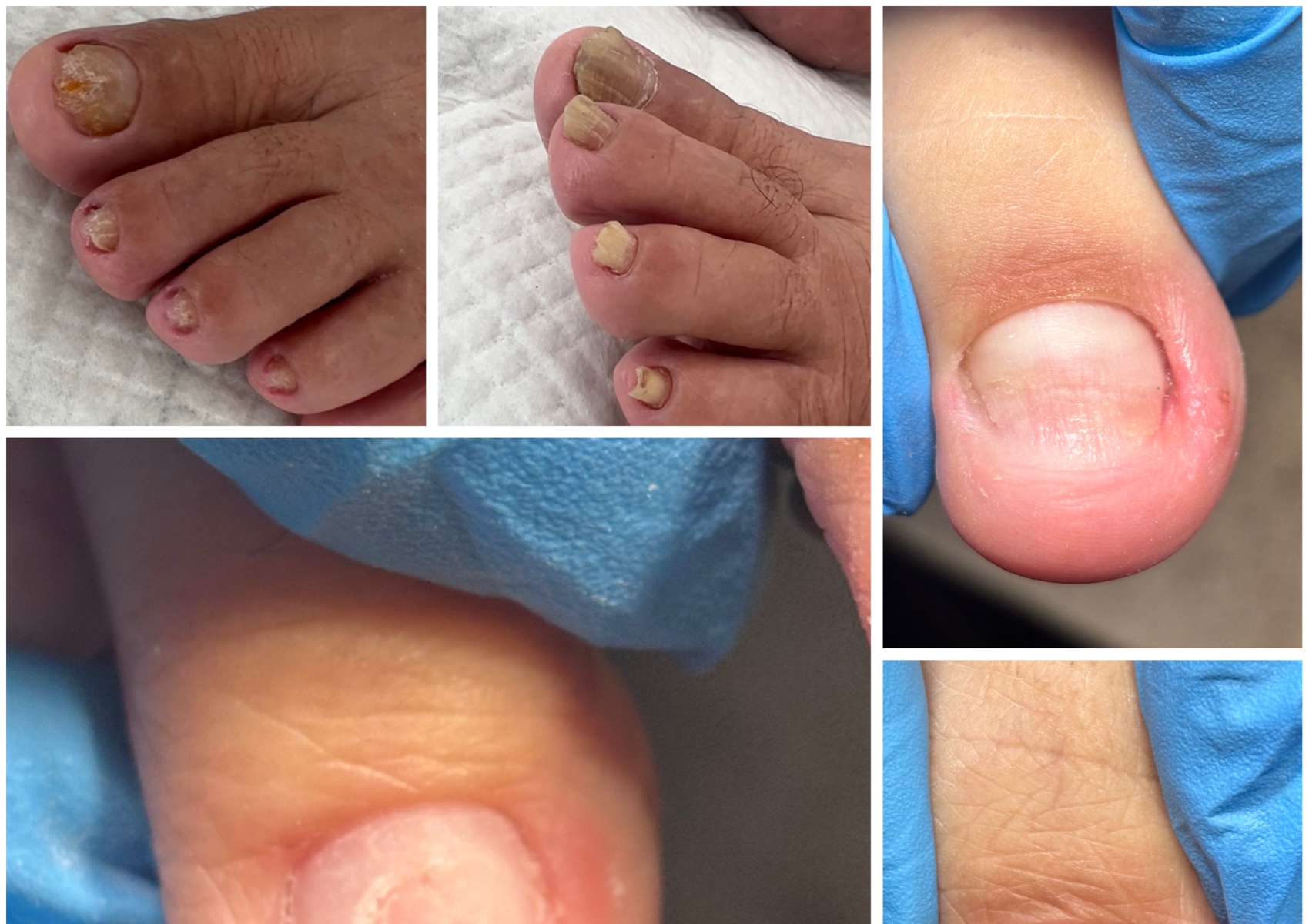 Limpieza profunda uñas traumadas