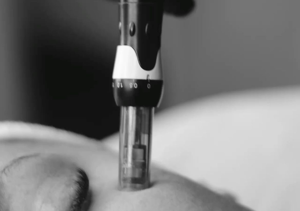 Skin Needling