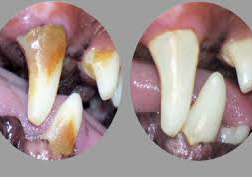 Teeth Scale Insizers 