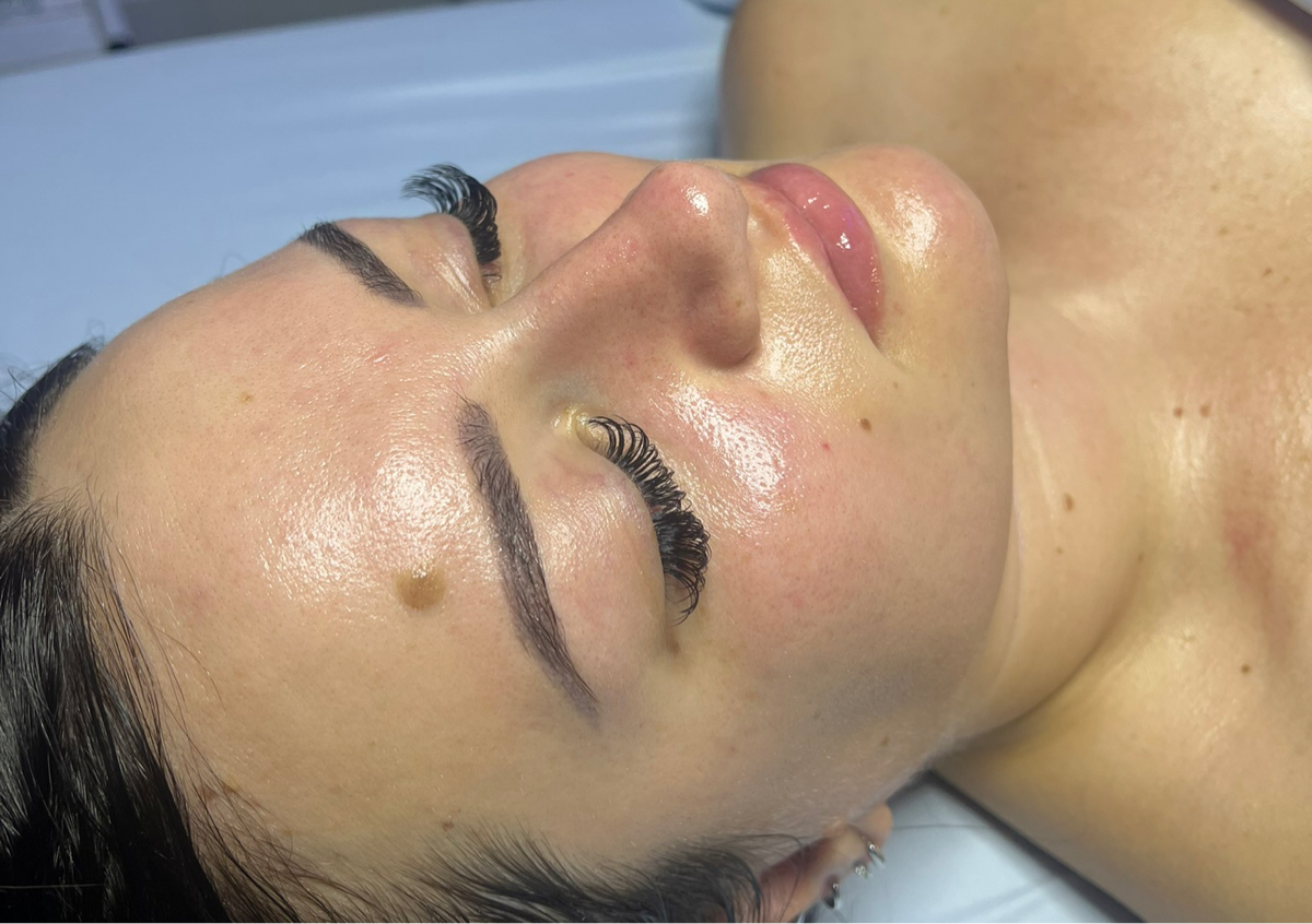 Microdermabrasion Facial