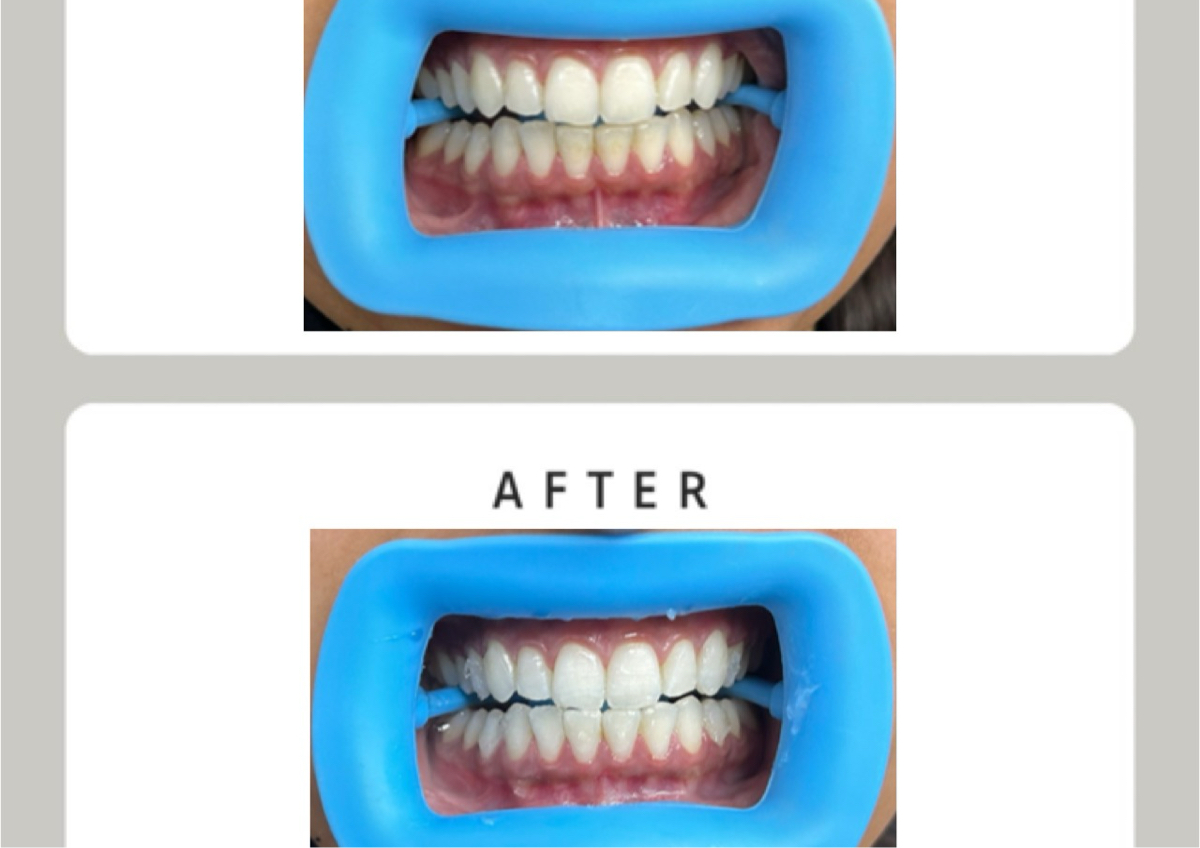 60 min - Advanced Whitening 
