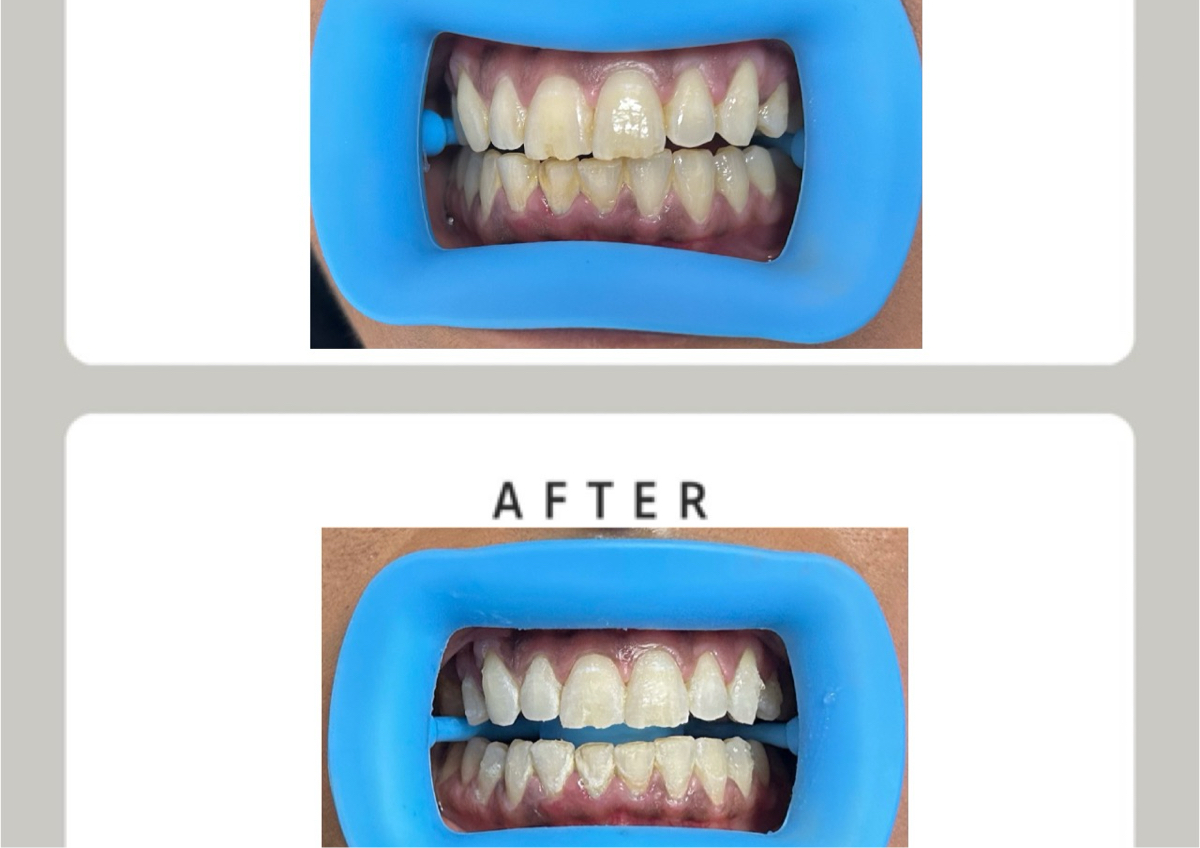 75 min - Deluxe Whitening