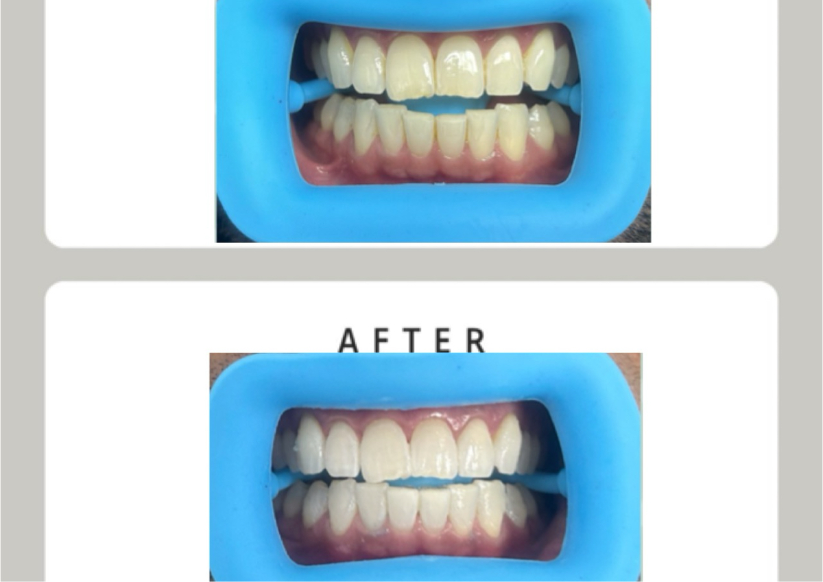 90 min - Ultra Bright Treatment