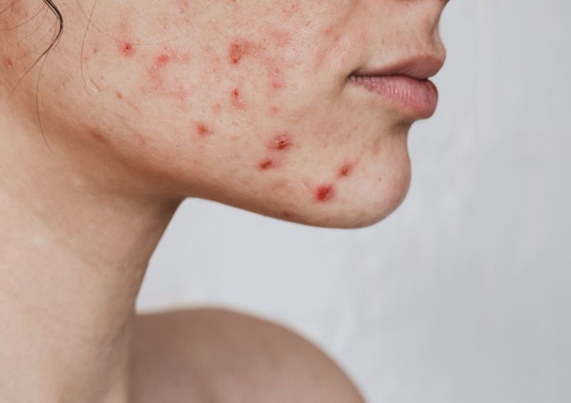 Facial Acne Detox 