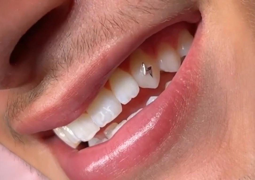 💎 White Gold Tooth Gem 💎