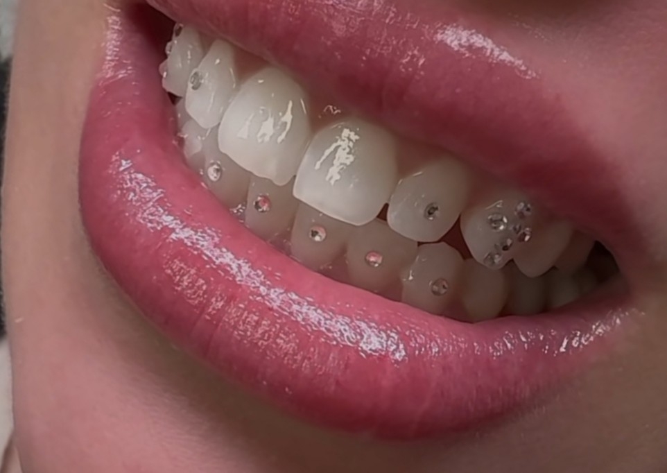 💎 Full Mouth Design Gems 💎