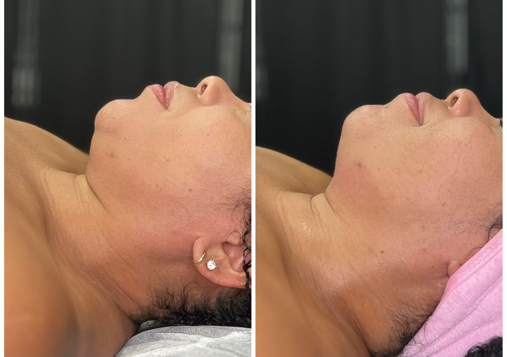 Face Lift Plus Non-Invasive Double Chin Tightning Treatment