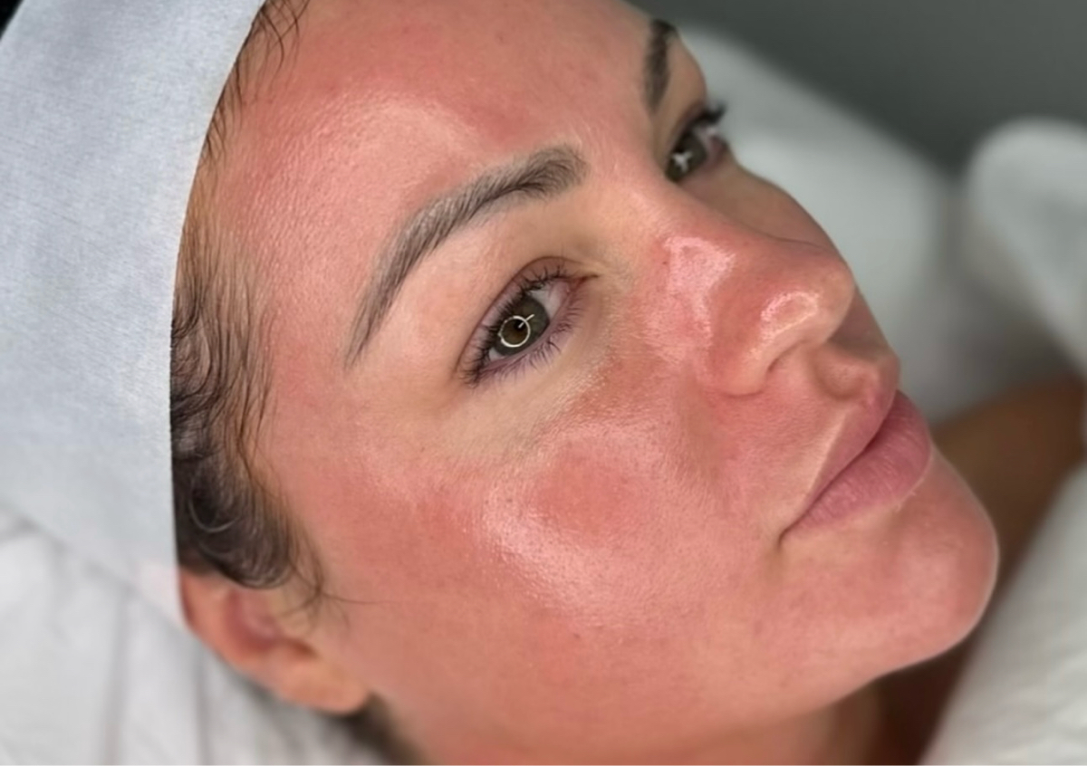 Microneedling Face 