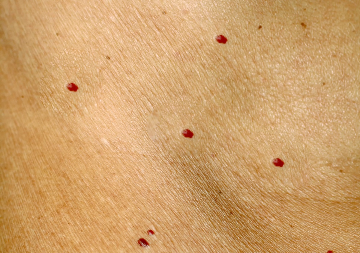 Angiomas