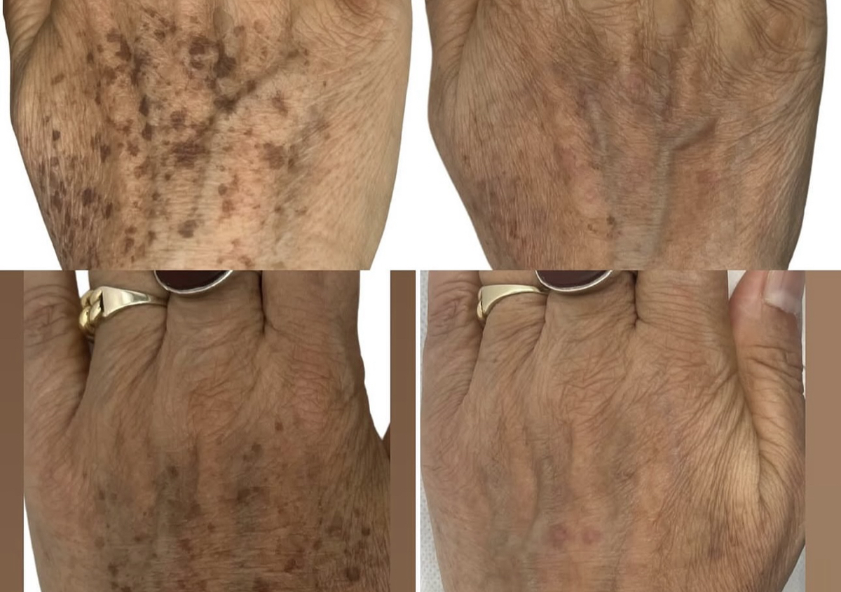 Pigmented Lesions(Sun Spots)