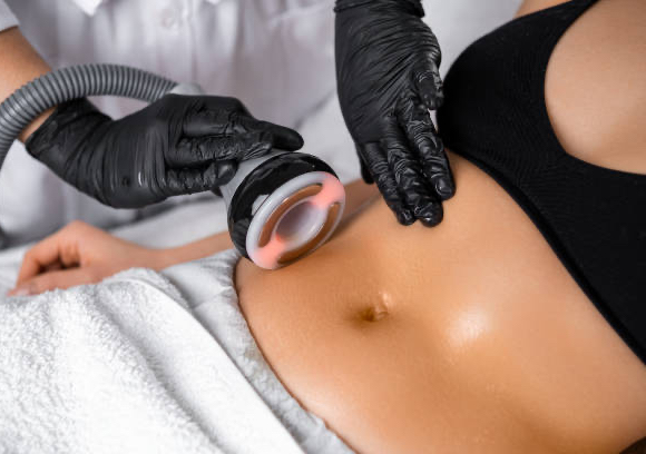 Lipocavitation 1 session