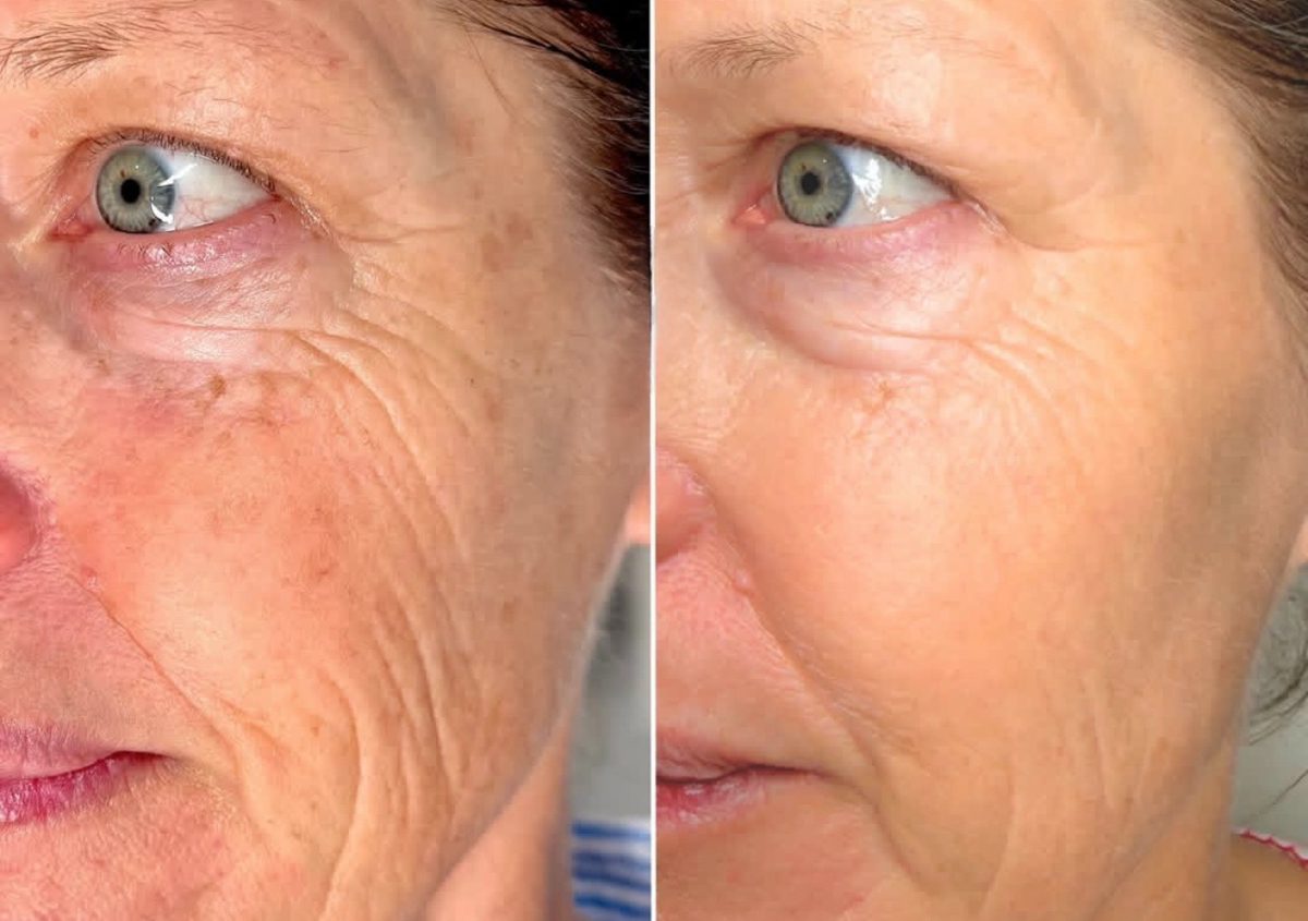 Skin Rejuvenation