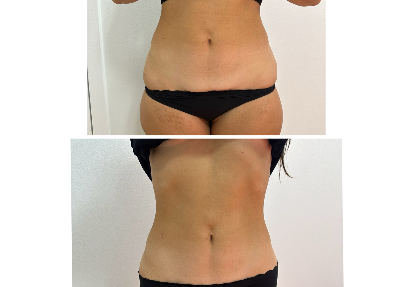 Lipocavitation 4 sessions 