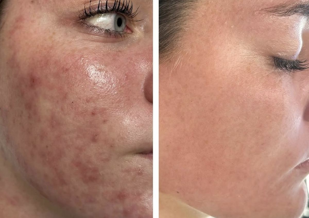 Neo Clear Acne 