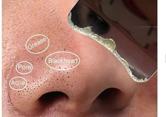 Blackhead Extraction