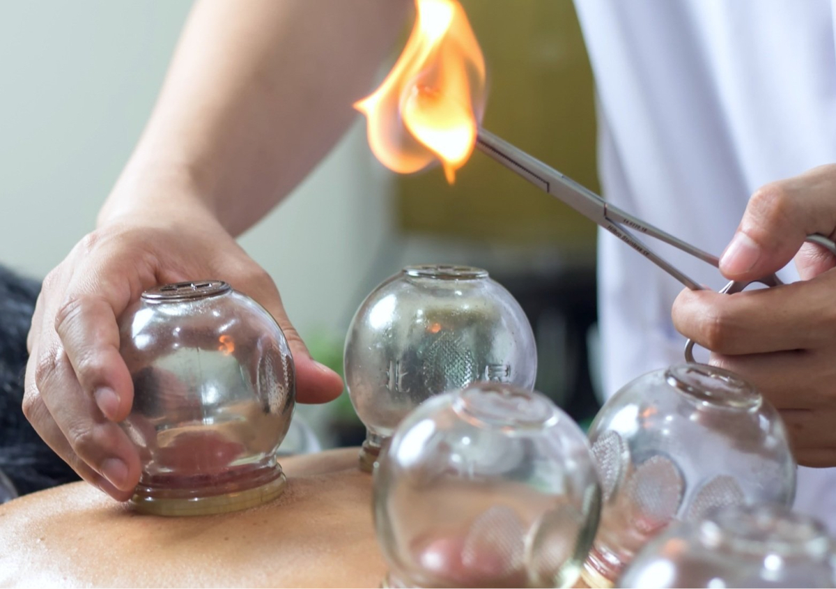 Traditional Chinese Fire Cupping