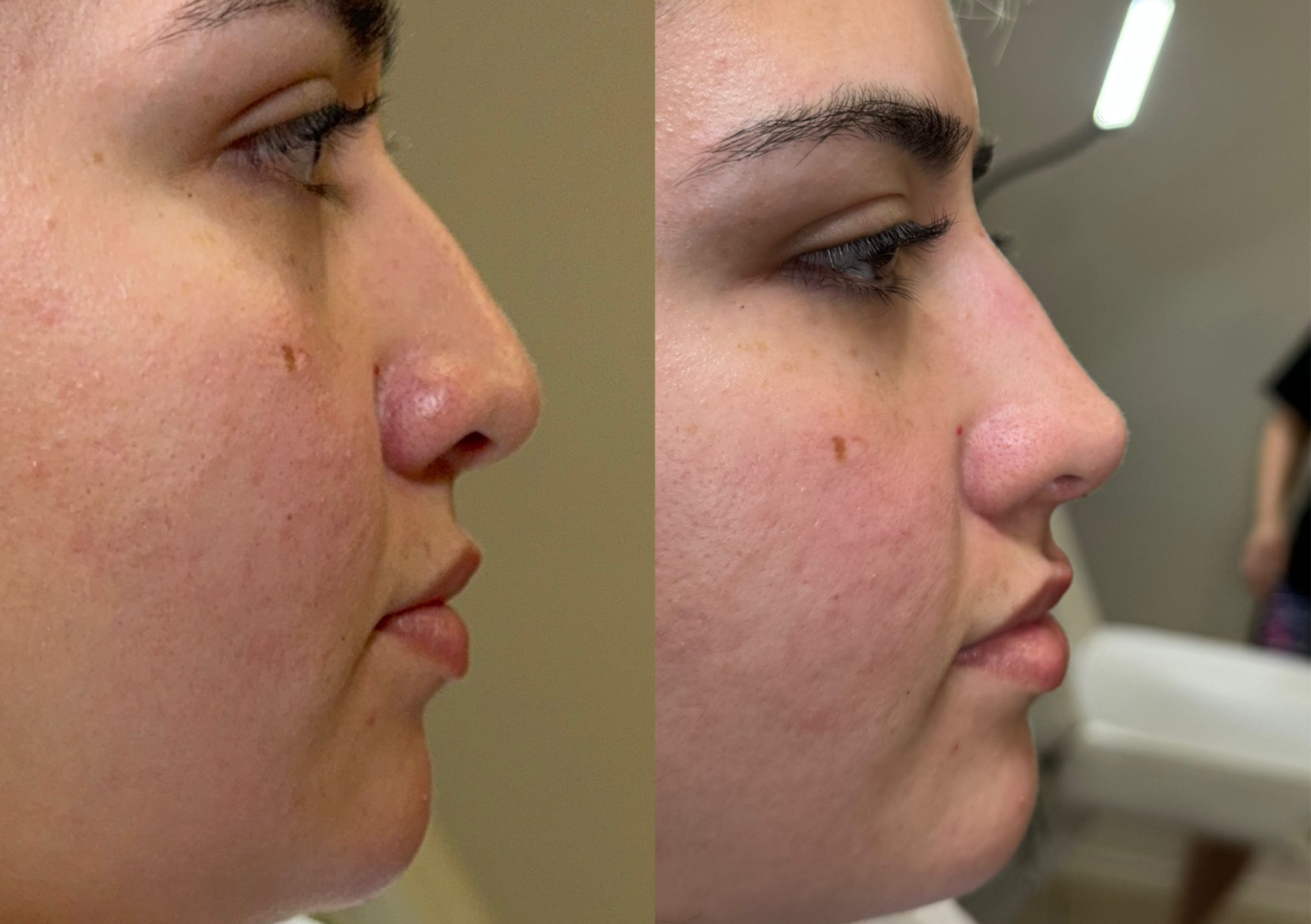 Non-Surgical Rhinoplasty 