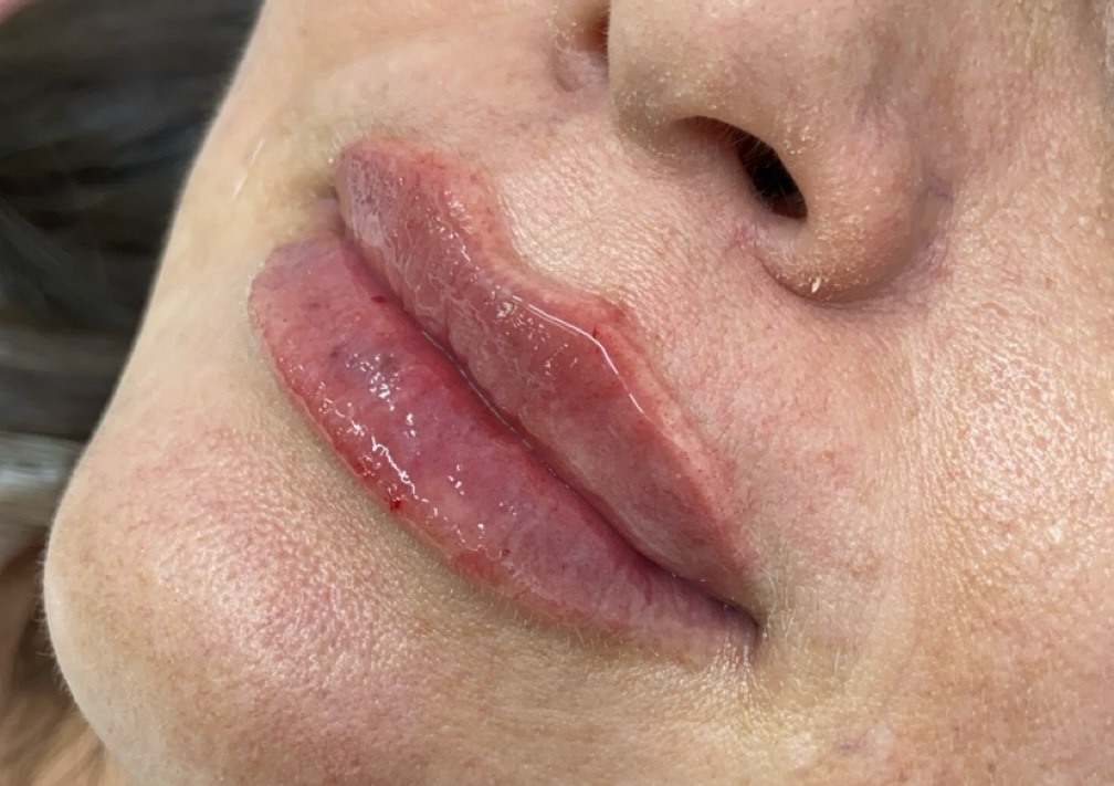 Lip Augmentation (filler) 1ml