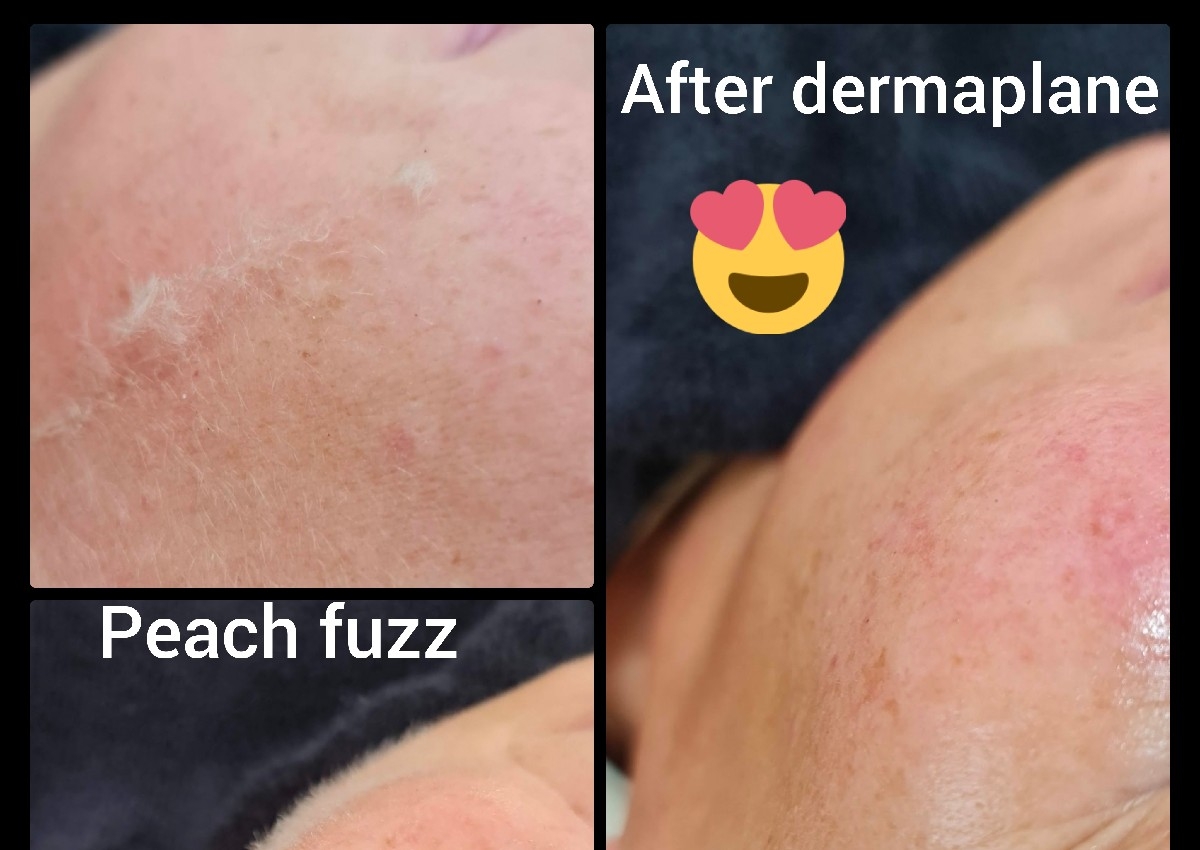 Dermaplane