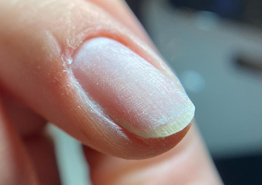 Depose semi-permanent 