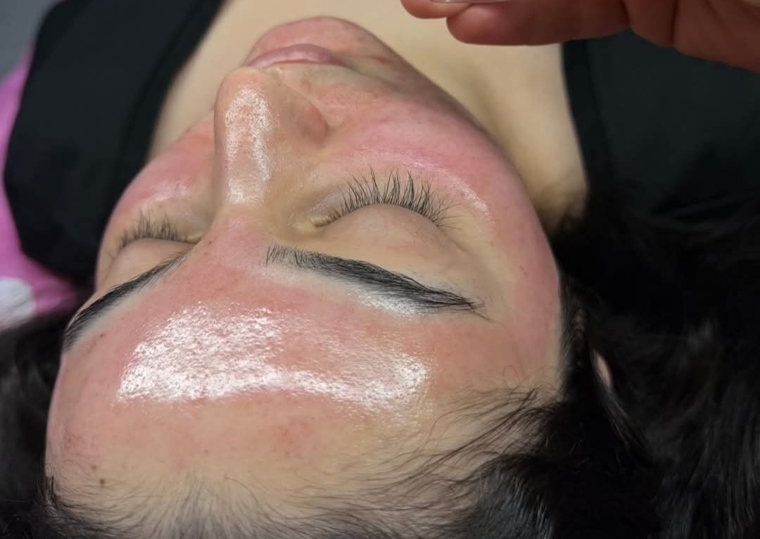 Microagujas/ Microneedling