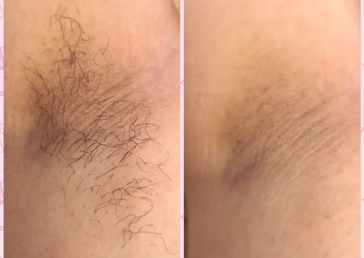 Axila/ underarm HLR