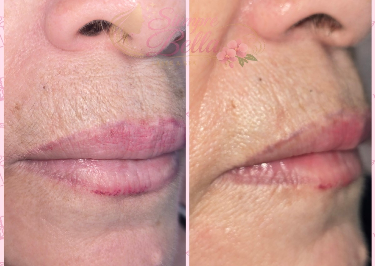 Bigote/ Upper lip hair laser removal