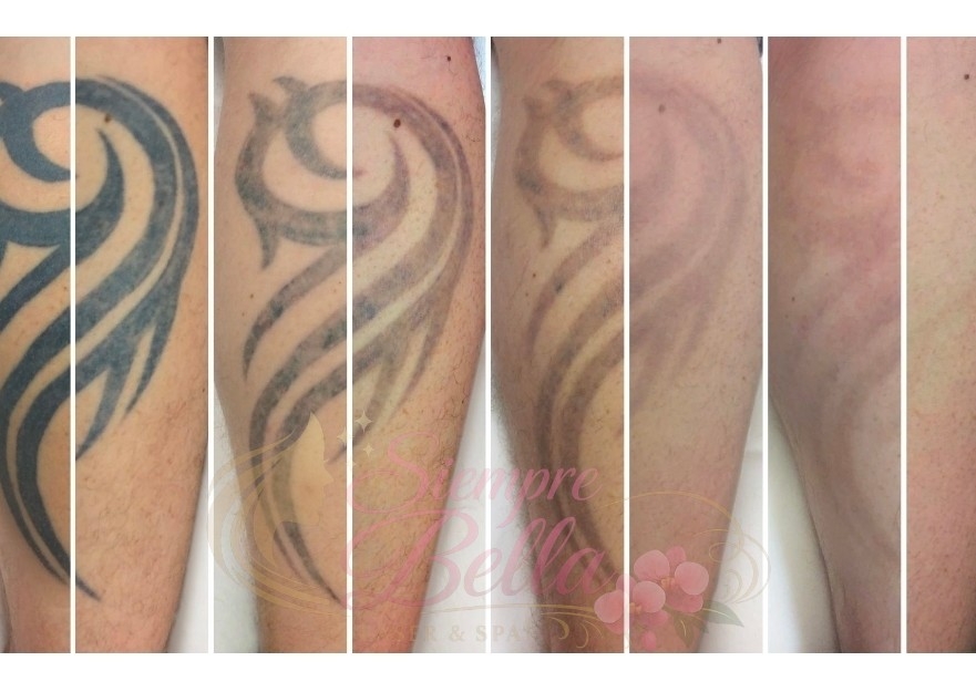Remocion tatuaje