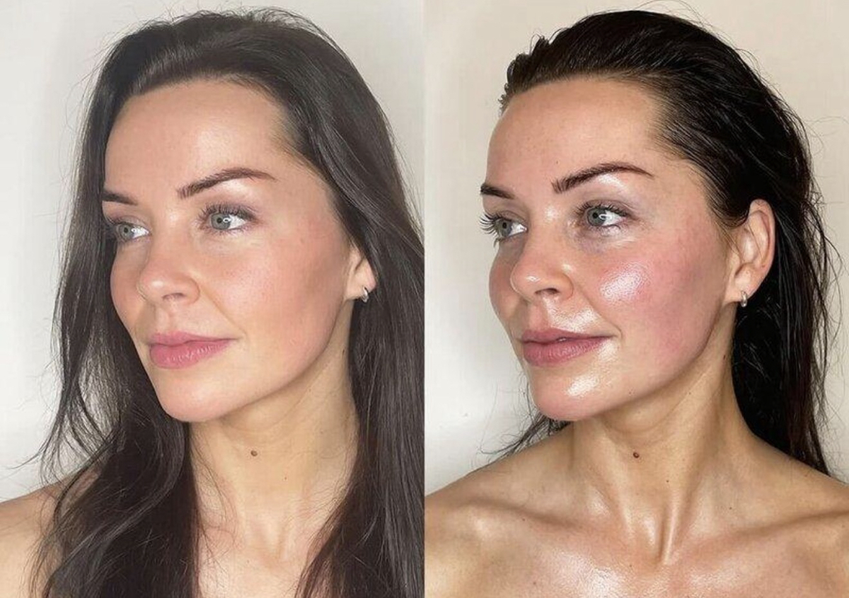 Radio frequency facial treatment