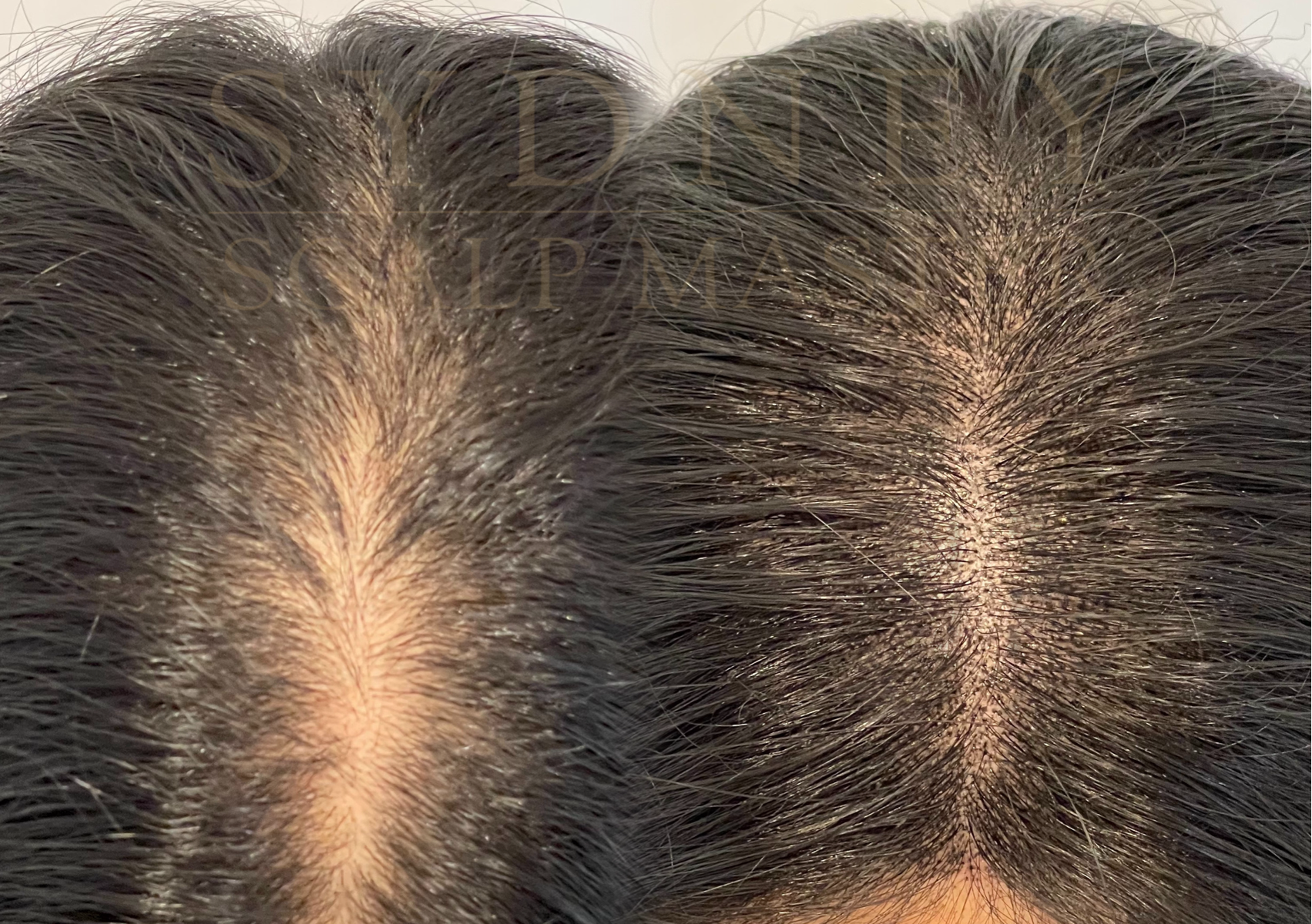 SCALP MICROPIGMENTATION for women