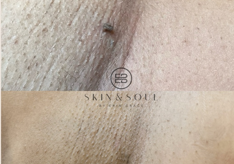 SKIN TAG REMOVAL per area unlimited