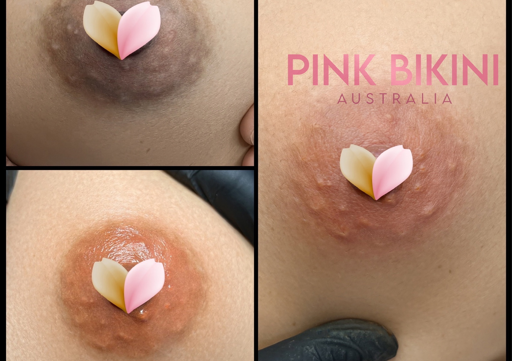 Areola Tattoo Brightening