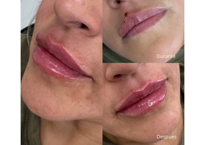 1 ML LIP FILLER