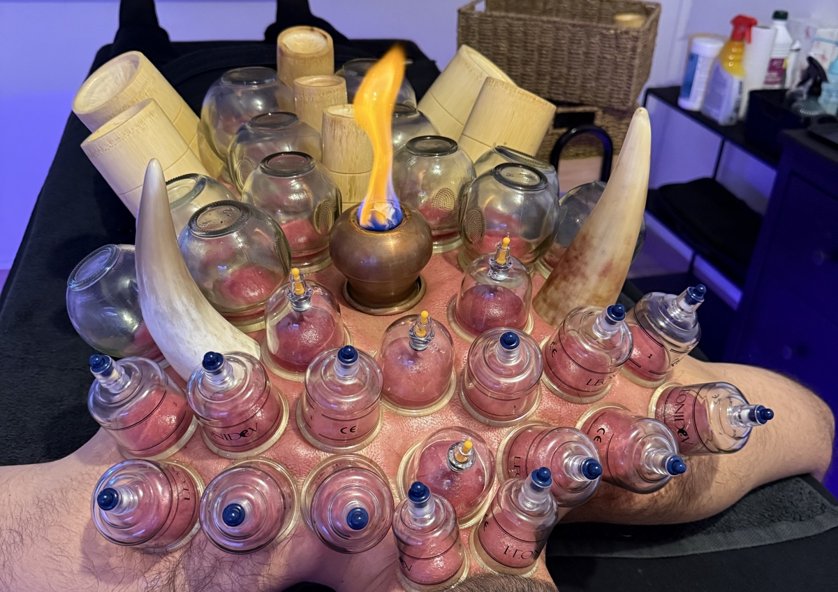 Hijama/cupping dos
