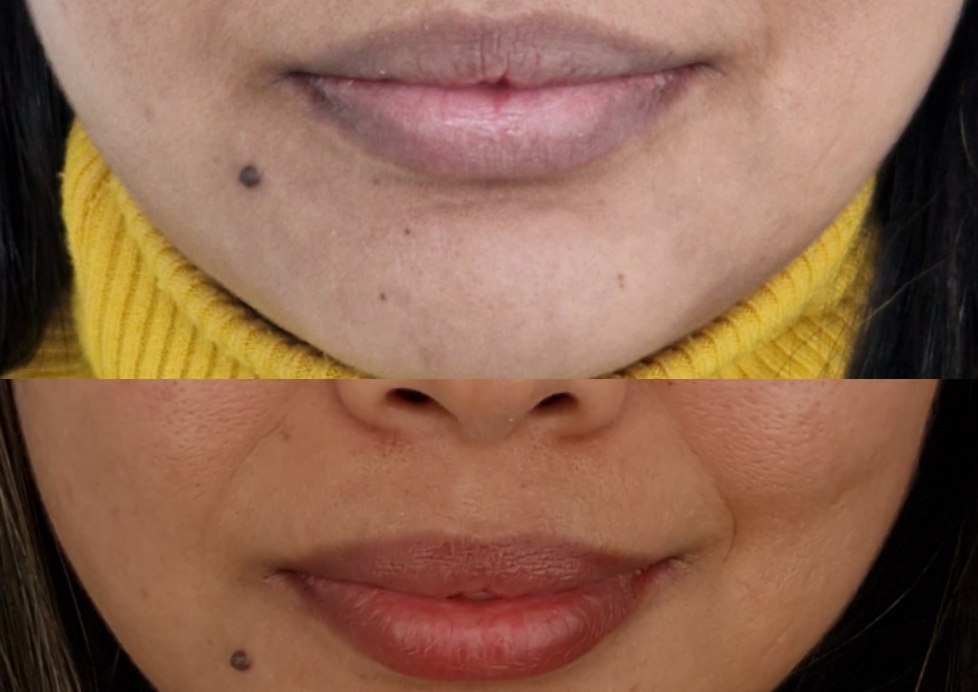 Dark lip Neutralization